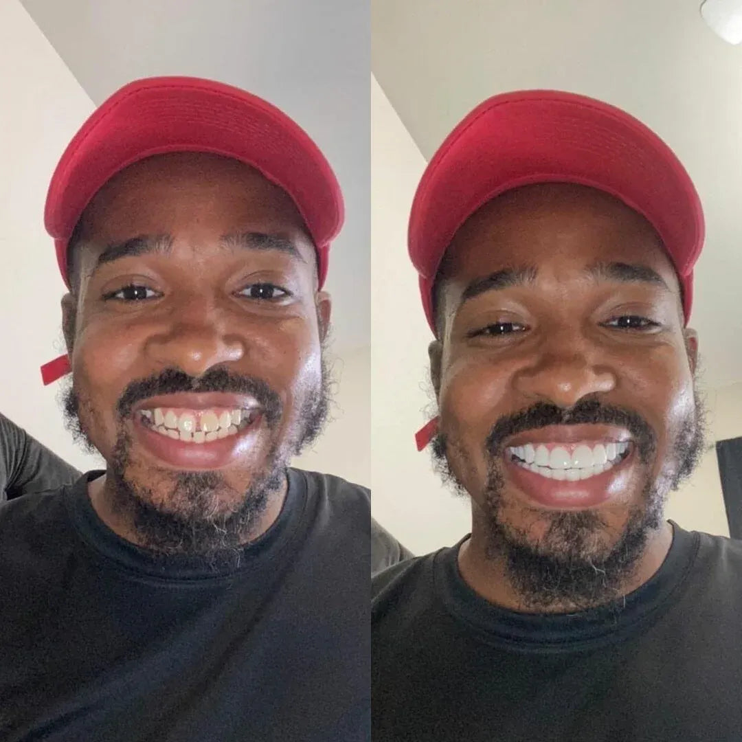 Clip-On Veneers