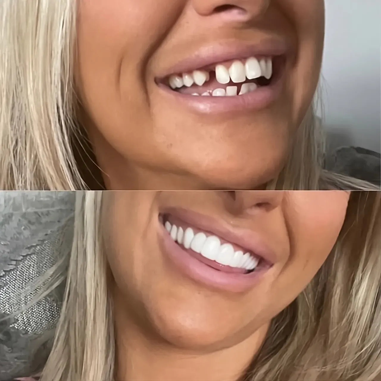 Clip-On Veneers